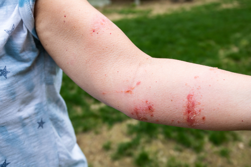 poison ivy rash